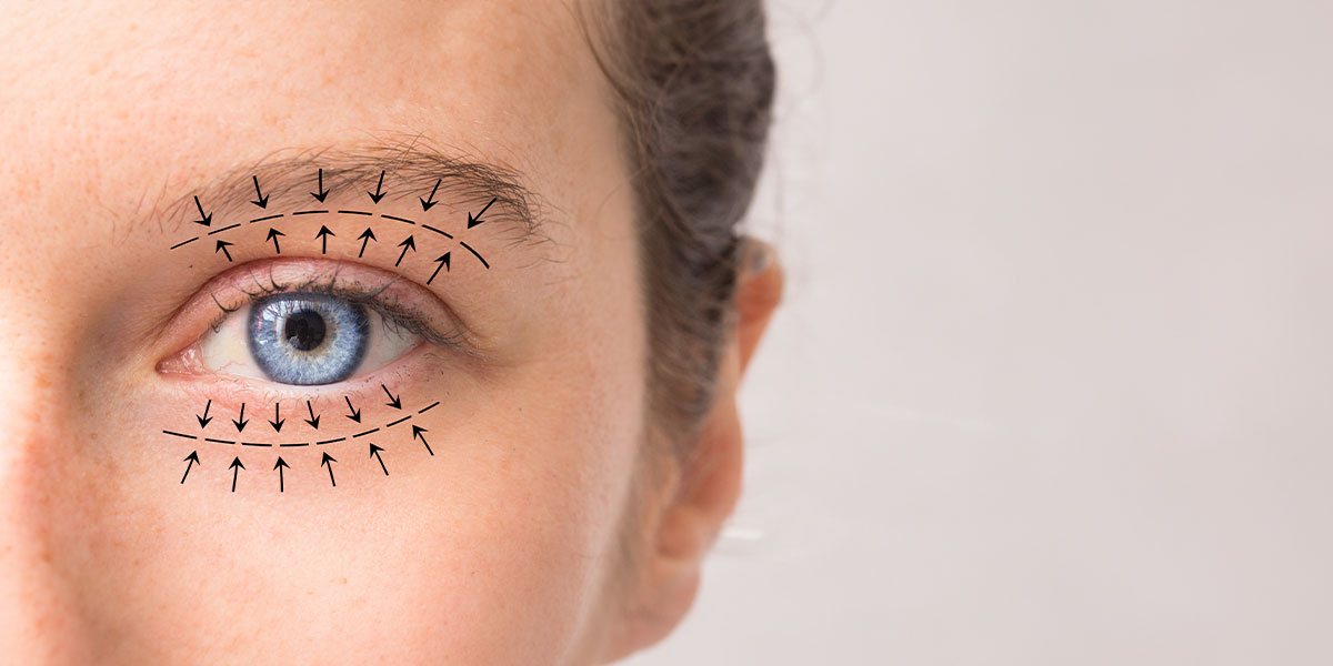 Blepharoplasty